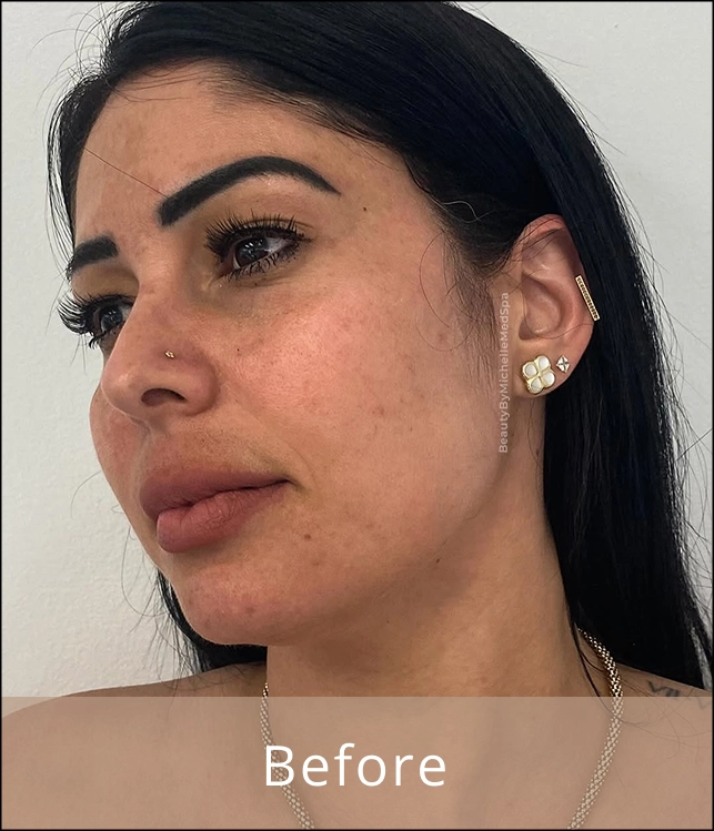 Patient 1 before acne treatment