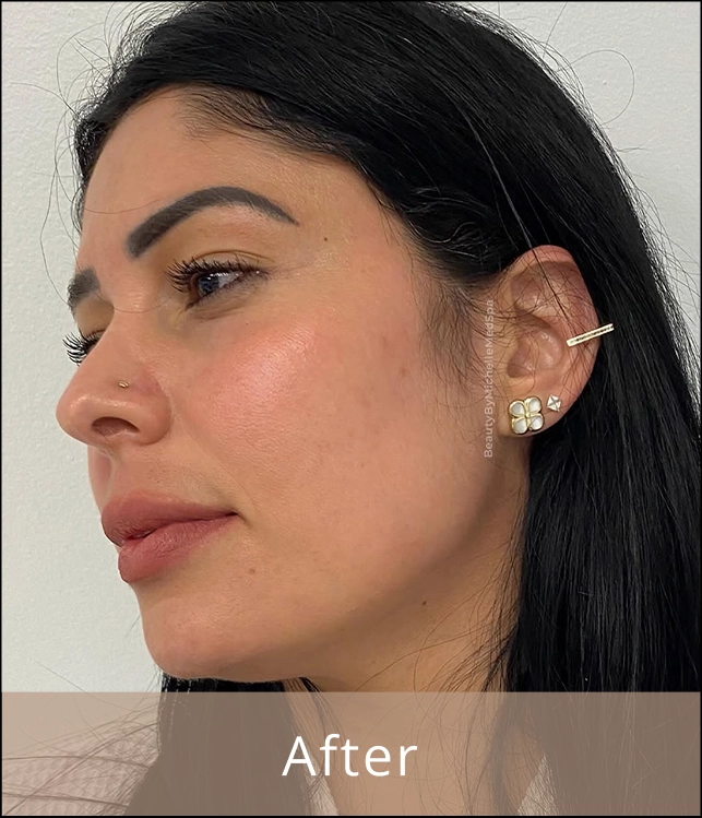 Patient 1 after acne treatment