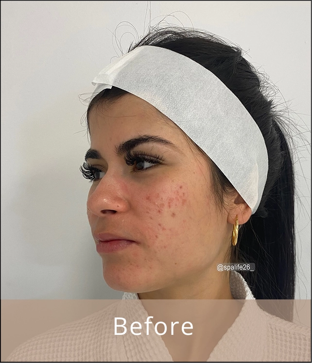 Patient 3 before acne treatment